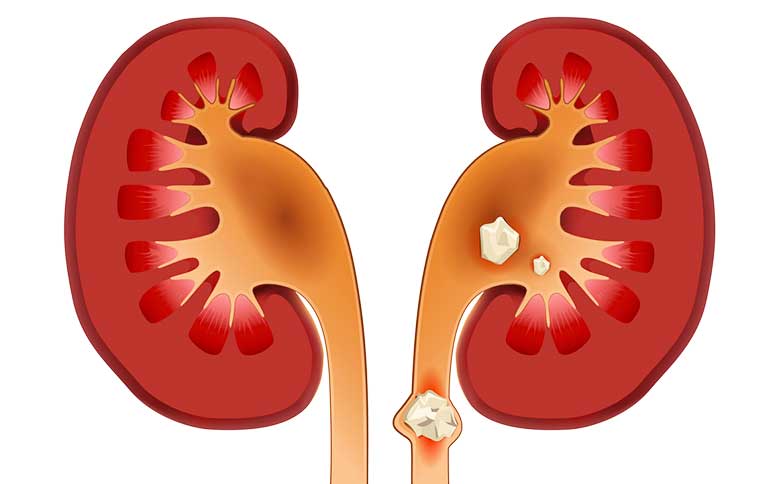 Bệnh gout dễ gây sỏi thận