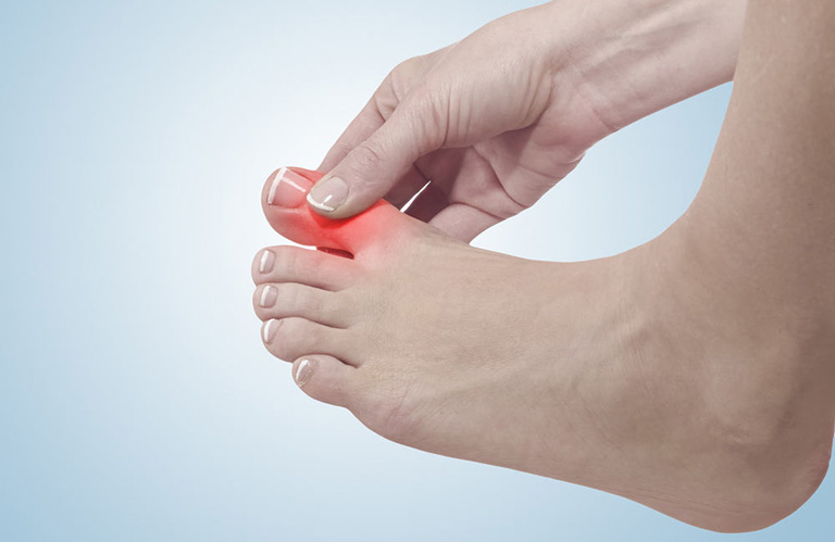  Cơn đau gút cấp thường khởi phát ở ngón chân cái