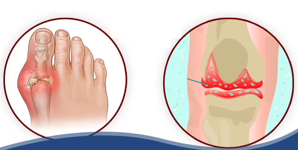 Vị trí cơn đau thường gặp của bệnh gút (bên trái) và bệnh giả gút
