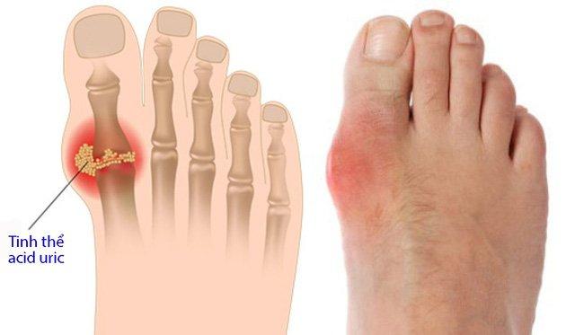 Dấu hiệu bệnh Gout ở chân và biện pháp khắc phục từ thảo dược