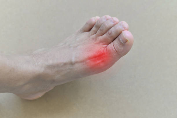 Cơn gút cấp thường bắt đầu ở khớp ngón chân cái