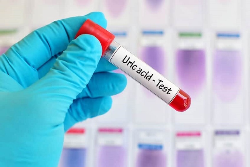 Người bệnh cần được xét nghiệm acid uric để chẩn đoán bệnh gút