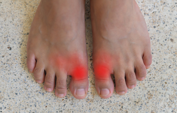 Cơn đau gút cấp thường khởi phát ở ngón chân cái