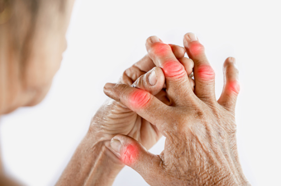 Cơn đau gút cấp gây đau đớn ở các khớp ngón tay