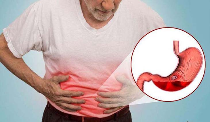 Dùng thuốc trị gout gia truyền bị đau dạ dày phải làm sao?