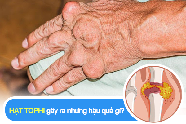 Tìm hiểu về hạt tophi – biến chứng nguy hiểm ở người bệnh Gout