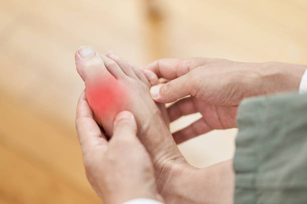 Bệnh gút thường đau ở khớp ngón chân cái