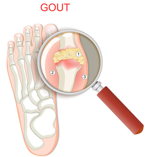 Bệnh gút là bệnh lý phổ biến gây đau ngón chân cái
