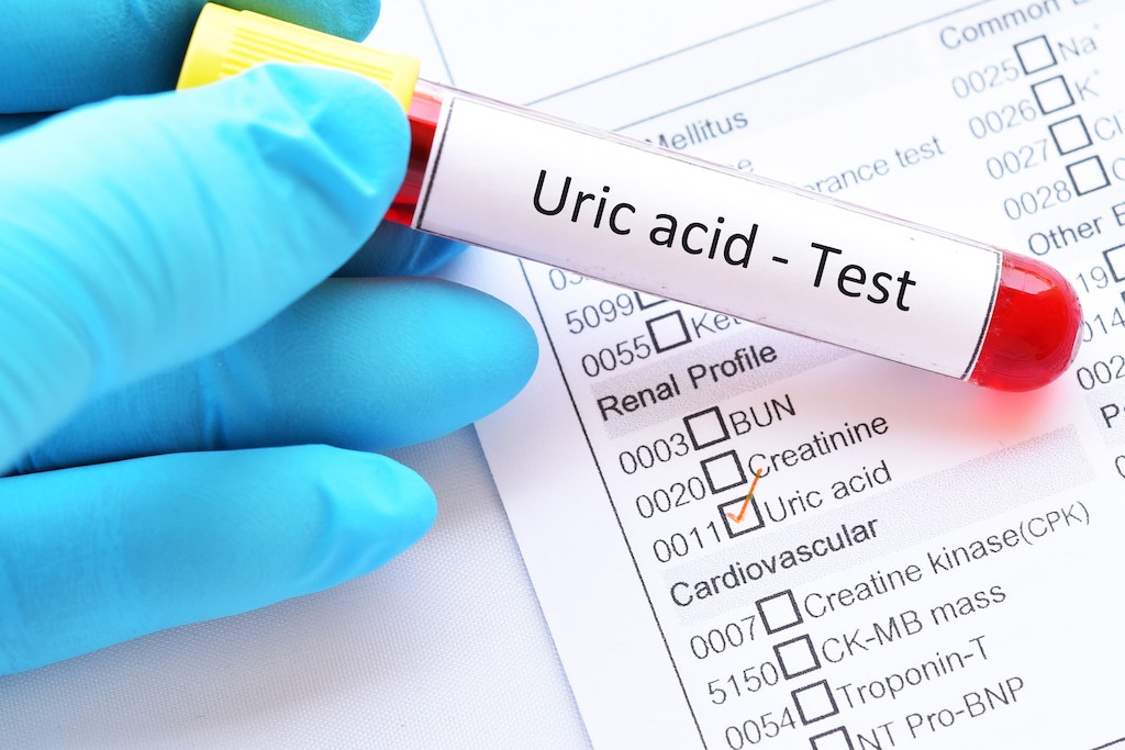 Cần có biện pháp hạ acid uric hiệu quả để kiểm soát tốt bệnh gút