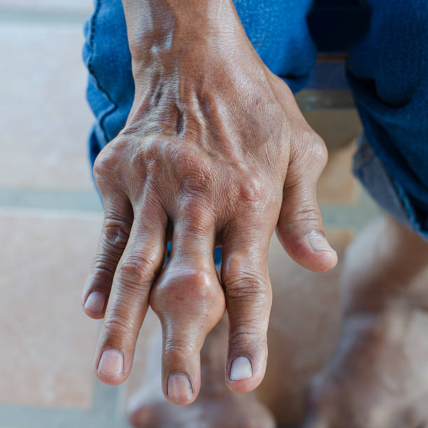 Bàn tay của người bệnh gút có biến chứng hạt tophi