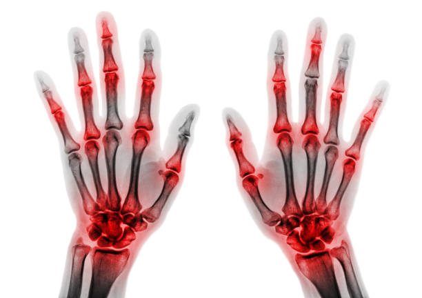 Viêm khớp dạng thấp gây sưng đau ở 1 hoặc cả 2 khớp ngón tay