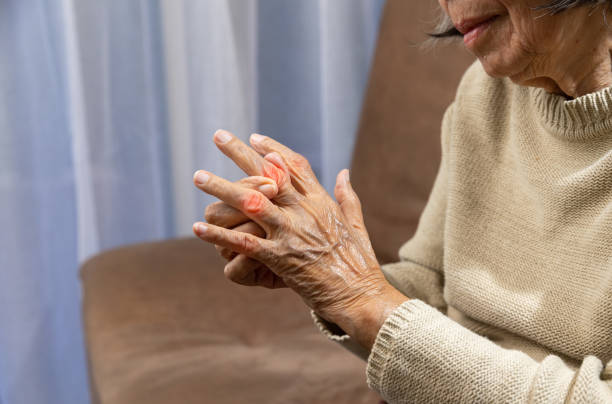 Viêm xương khớp thường gây sưng đau các khớp ngón tay ở người cao tuổi