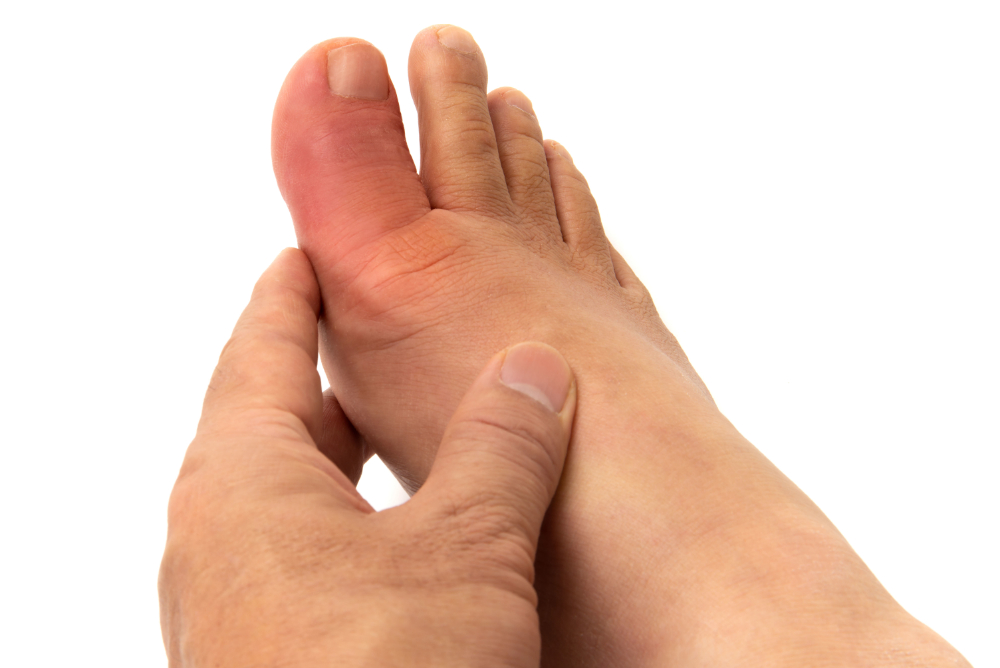 Đau ngón cái - Dấu hiệu bệnh gút ở chân bạn không thể bỏ qua