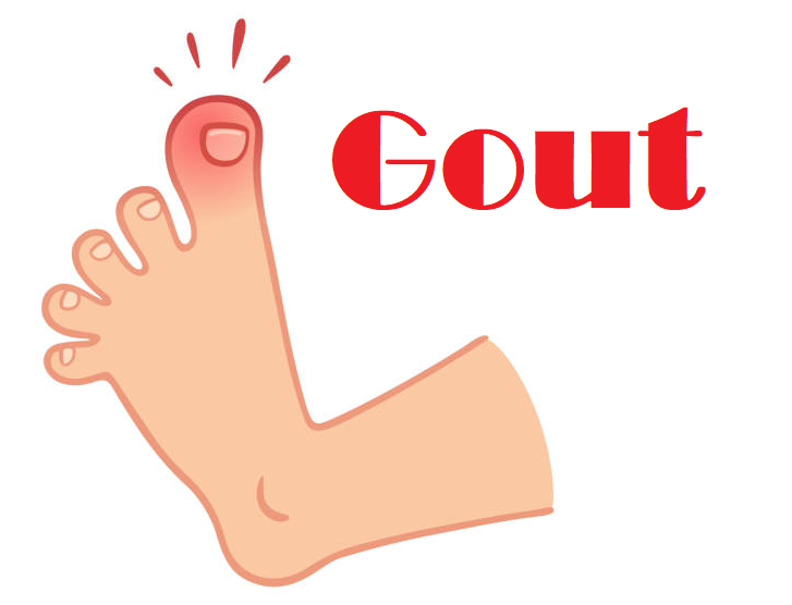  Đau ngón cái - Dấu hiệu bệnh gút ở chân bạn không thể bỏ qua
