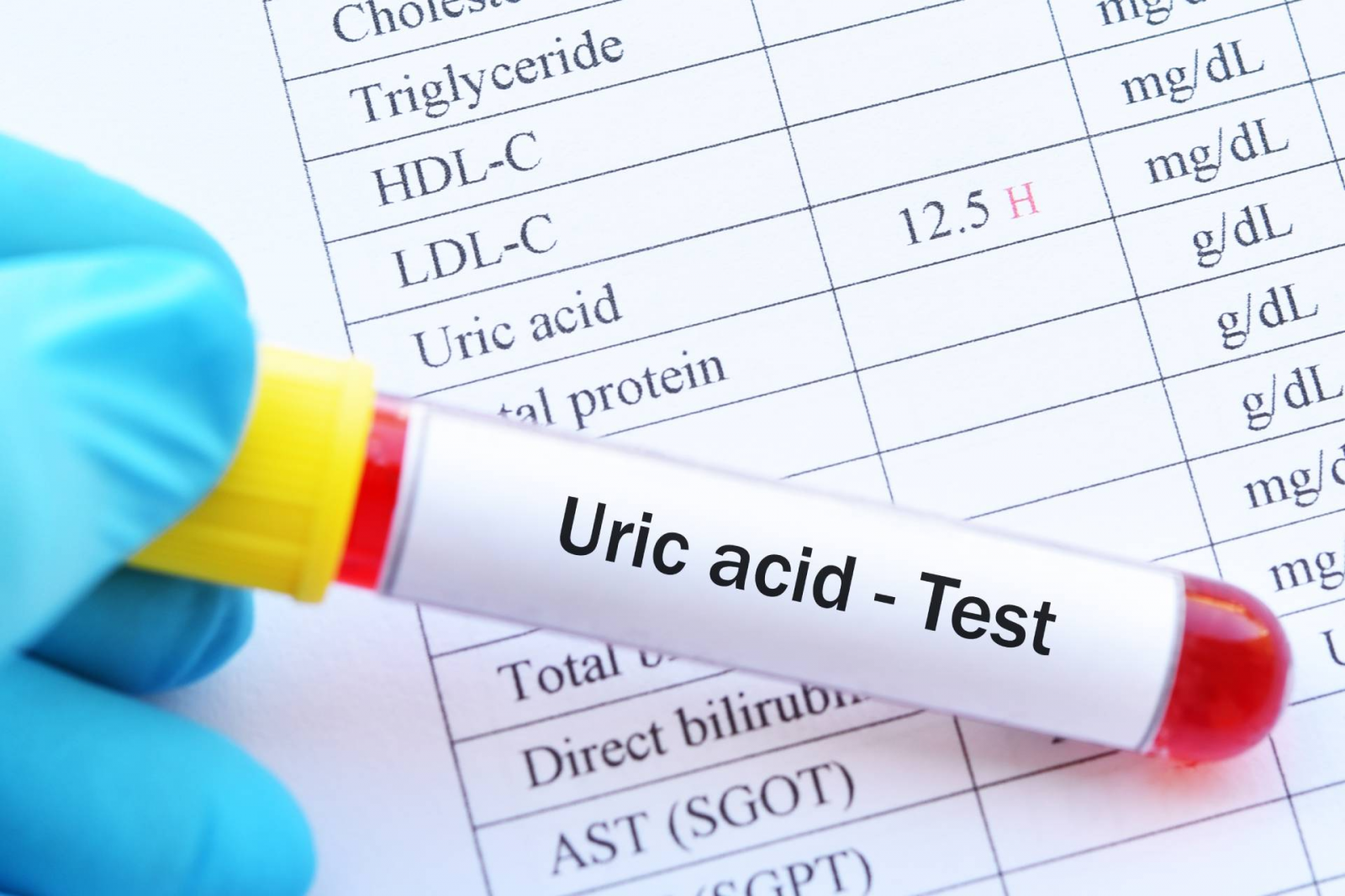 Kiểm tra acid uric để chẩn đoán bệnh gút