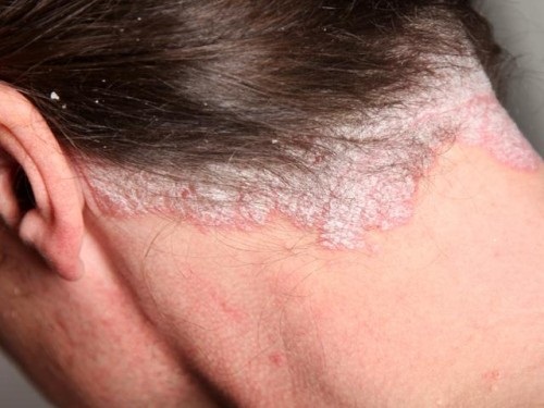 Bệnh da đầu gây rụng tóc