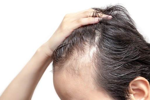Các bài thuốc đông y chữa rụng tóc liệu có hiệu quả?