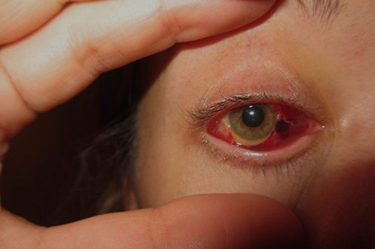 Biến chứng mắt ở bệnh nhân tiểu đường type 2