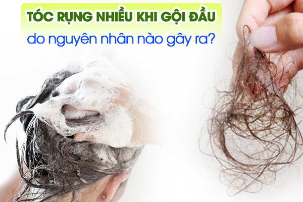 Tóc rụng nhiều khi gội đầu do nguyên nhân nào gây ra?