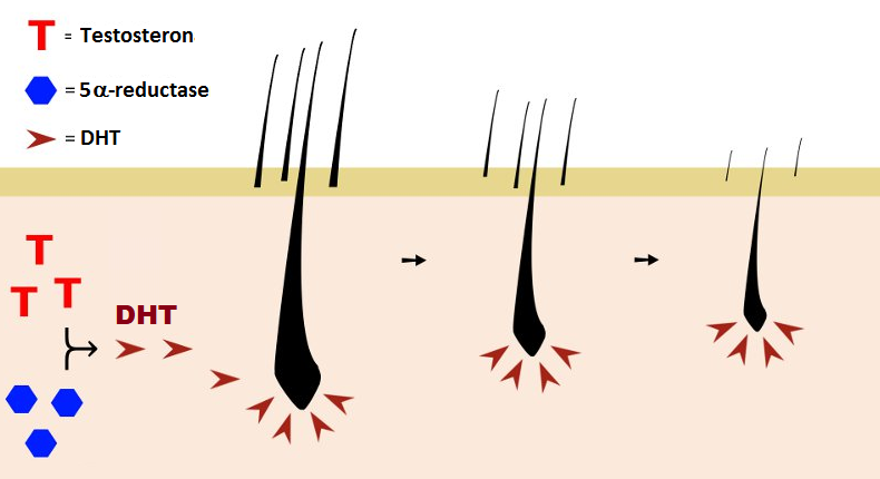 DHT gây rụng tóc, ngăn tóc mọc trở lại