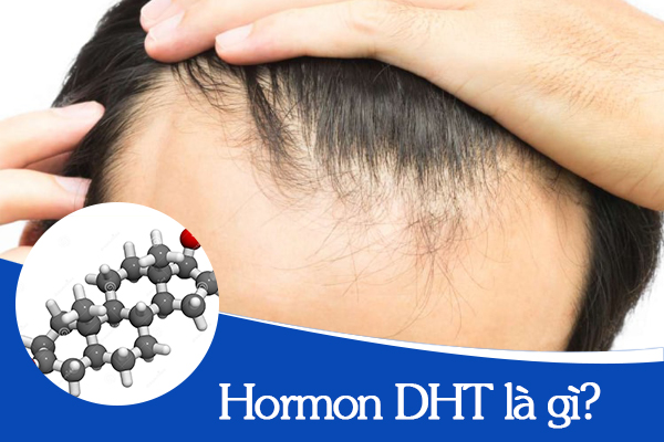 Hormon DHT là gì? Vì sao lại nói nó là thủ phạm gây rụng tóc, hói đầu?