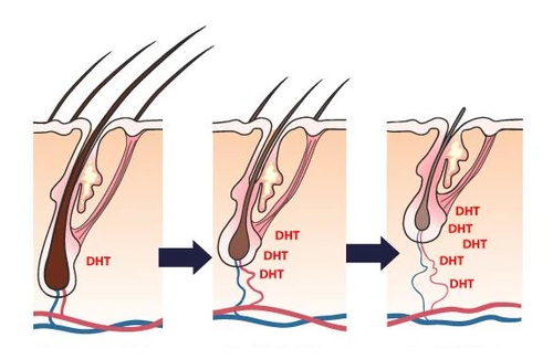 DHT là thủ phạm hàng đầu gây tóc rụng nhiều