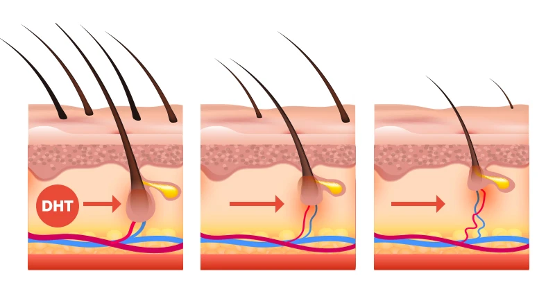 DHT là nguyên nhân hàng đầu khiến tóc rụng và khó mọc lại