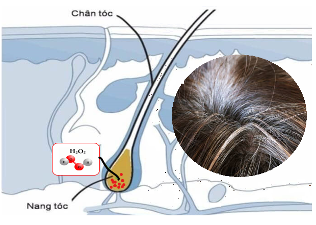 H2O2 tích tụ trong nang tóc là thủ phạm hàng đầu gây tóc bạc sớm