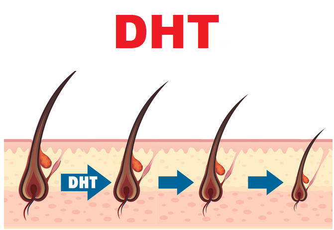 DHT làm cho các nang tóc bị teo nhỏ.