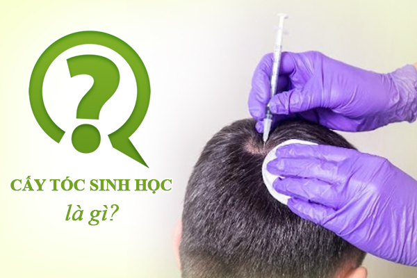Những thông tin cần biết về phương pháp cấy tóc sinh học cho người đang bị rụng tóc