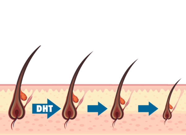 DHT là nguyên nhân rụng tóc nhiều thường gặp