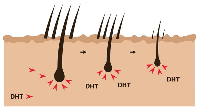 DHT là thủ phạm khiến tóc bị rụng, khó mọc lại và kém phát triển