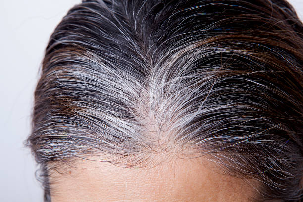 Nguyên nhân gây bạc tóc là gì?
