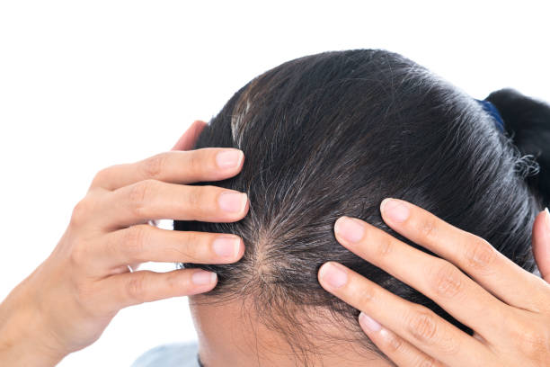 Giải pháp nào khắc phục tình trạng tóc bạc sớm?