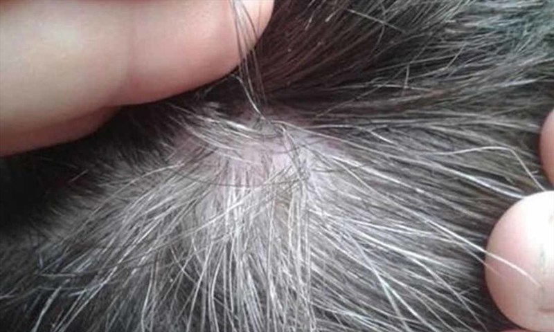 Nhổ tóc bạc sẽ khiến vùng bị bạc tóc lan rộng ra