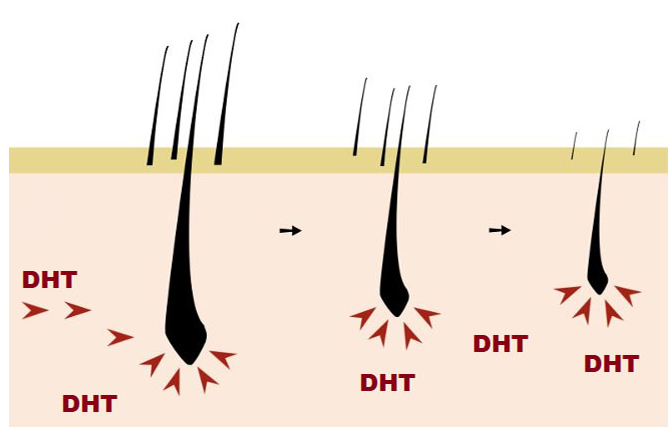 DHT tác động làm tóc rụng nhiều