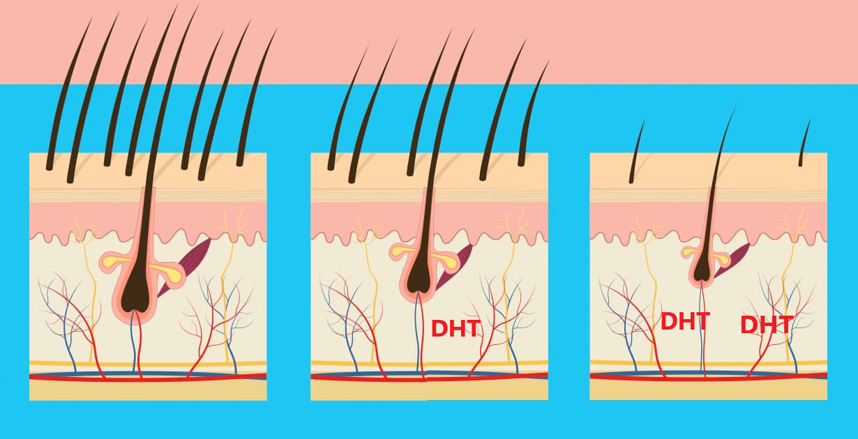 DHT là nguyên nhân khiến hoạt động của nang tóc chậm lại, làm tóc lâu dài
