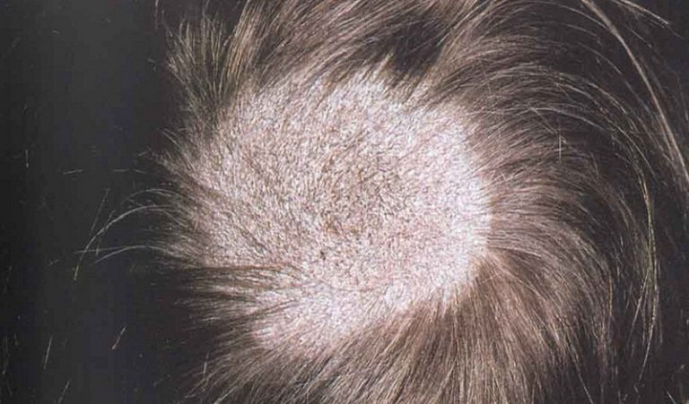 Nếu nguyên nhân gây rụng tóc là nấm tóc, bạn cần tập trung điều trị dứt điểm bệnh lý này