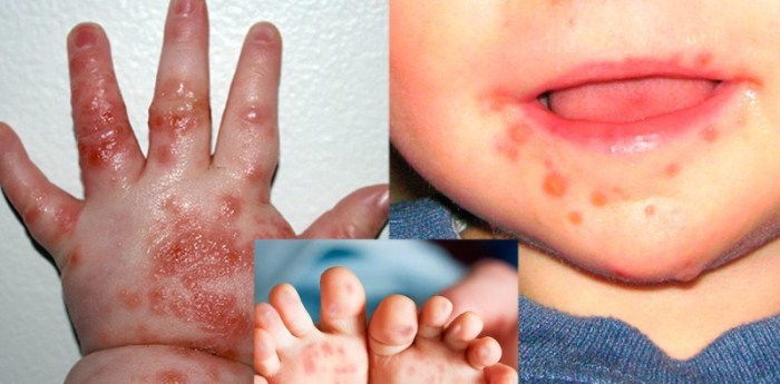 Dấu hiệu của bệnh tay chân miệng ở trẻ