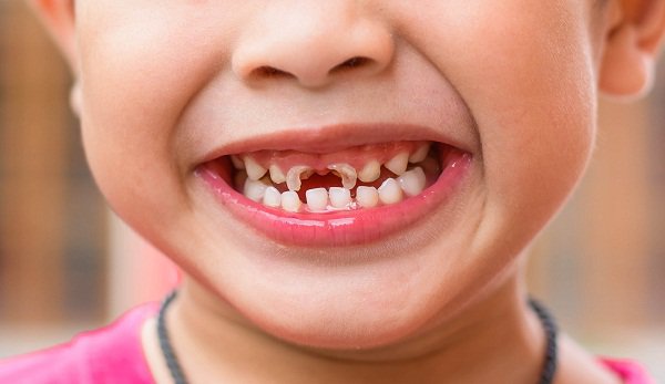Xử trí một số tình huống khẩn cấp trong điều trị chỉnh hình răng mặt ở trẻ em