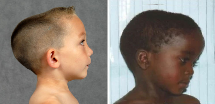 Trẻ bị còi xương có các bất thường ở vùng xương đầu, bao gồm thóp rộng và mềm