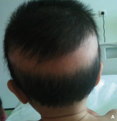 Trẻ bị còi xương có tóc rụng nhiều, đặc biệt là ở vùng sau gáy như hình vành khăn