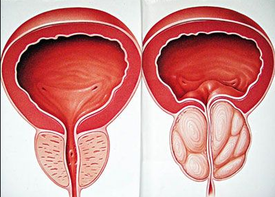 Phì đại tuyến tiền liệt là nguyên nhân hàng đầu gây ra tình trạng tiểu không kiểm soát ở nam giới