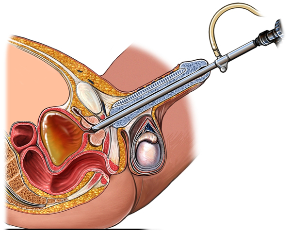 Phẫu thuật nội soi qua ống niệu đạo