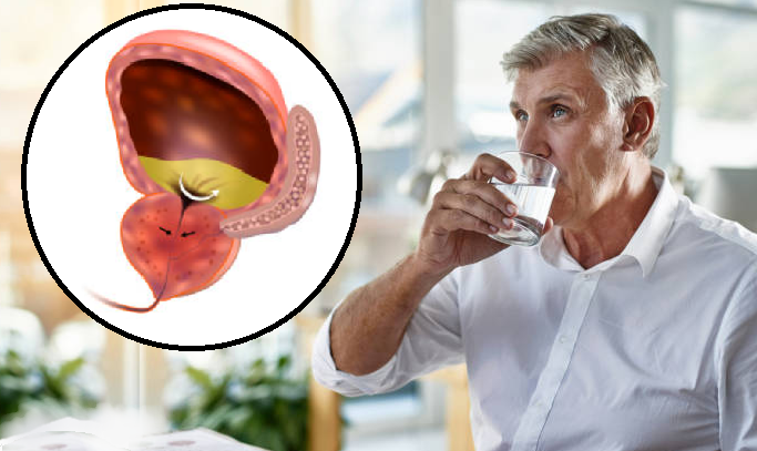 Người bệnh phì đại tuyến tiền liệt nên uống gì và uống như thế nào?