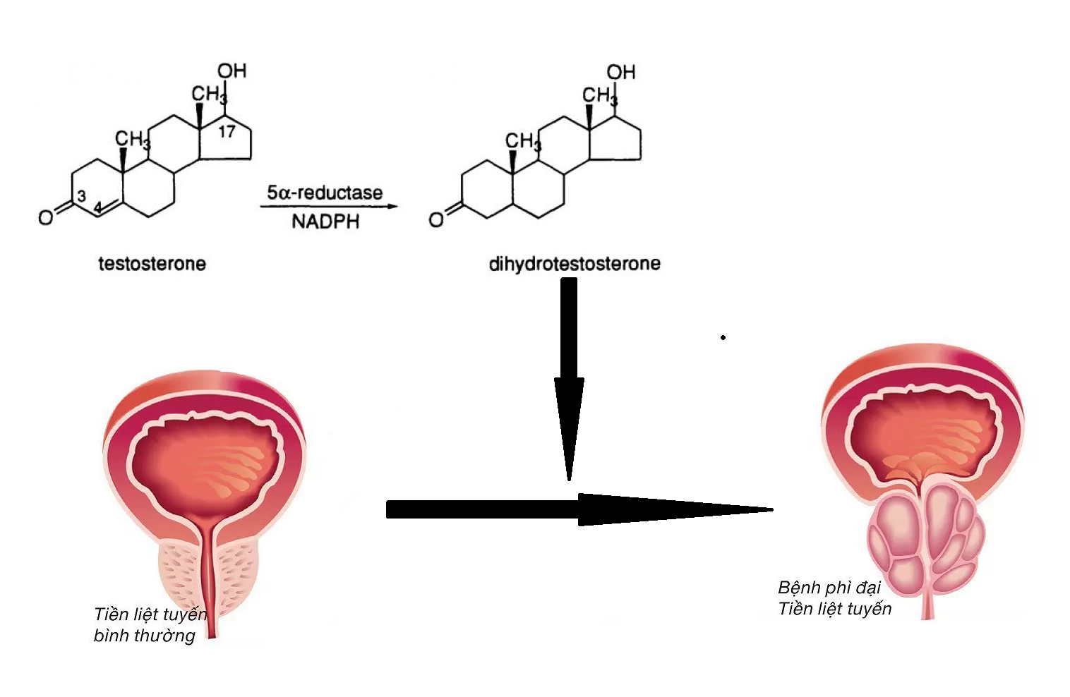  Sự tăng nồng độ dihydrotestosterone là nguyên nhân gốc gây phì đại tuyến tiền liệt