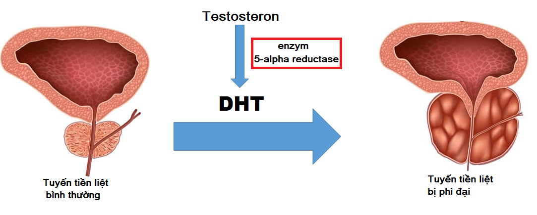 DHT là tác nhân gây phì đại tuyến tiền liệt