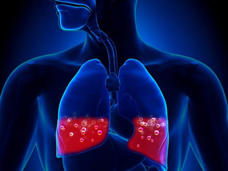 Khi gặp biến chứng suy thận, người bệnh có thể gặp tình trạng phù phổi