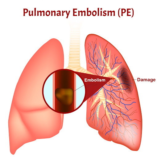Huyết khối theo dòng máu về tim, đi lên phổi gây thuyên tắc mạch phổi. Đây là biến chứng nặng nề nhất