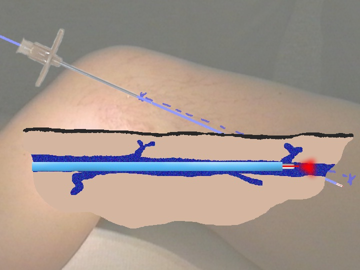 Cách chữa bệnh suy giãn tĩnh mạch bằng phương pháp laser
